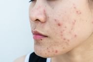 Cold sore and pimple (Image via BOY_ANUPONG/Getty Images)